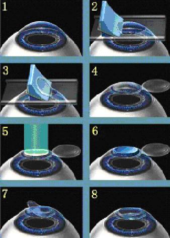 laser vision correction