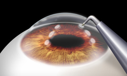 conductive keratoplasty