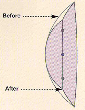 conductive keratoplasty