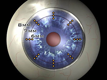 conductive keratoplasty