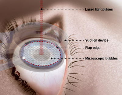 laser vision correction