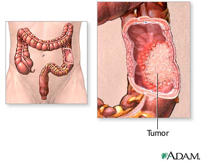 ulcerative colitis diet