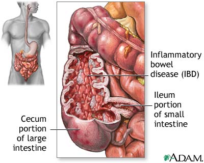 ibd colitis