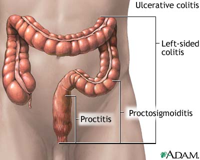 ulcerative colitis diet