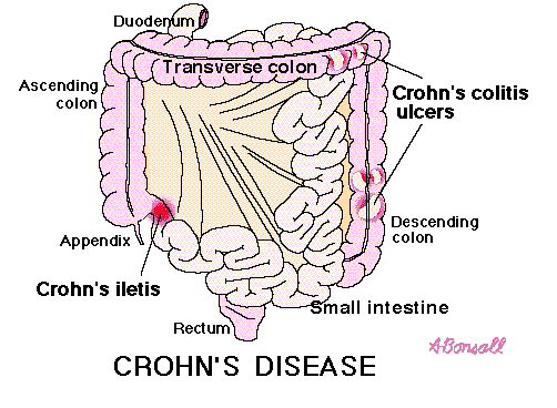 crohn