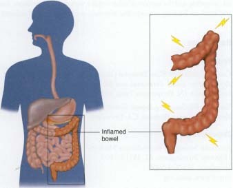 ibd symptoms