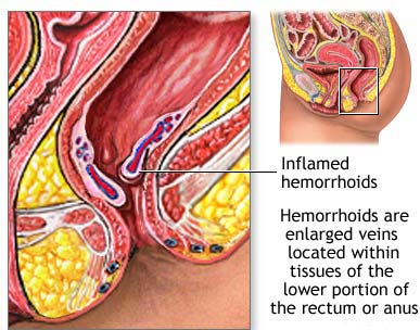 ibd symptoms