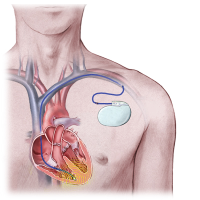 icd pacemakers