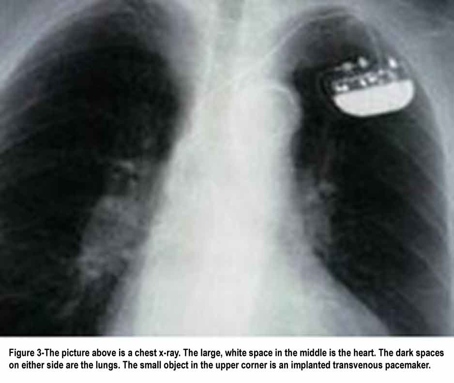 icd pacemakers