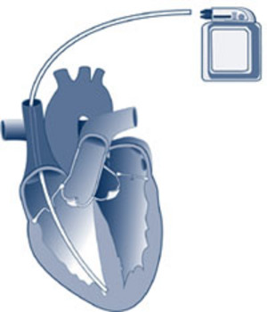 icd procedure