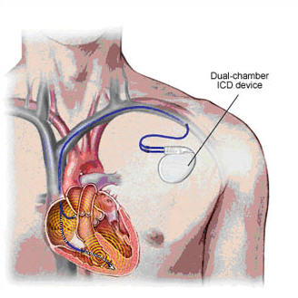 icd cardiac