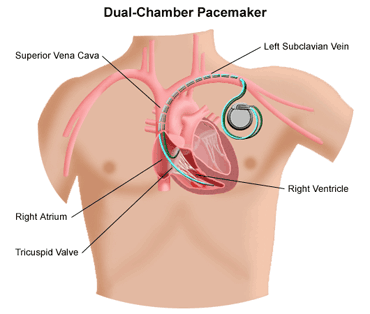 icd procedure