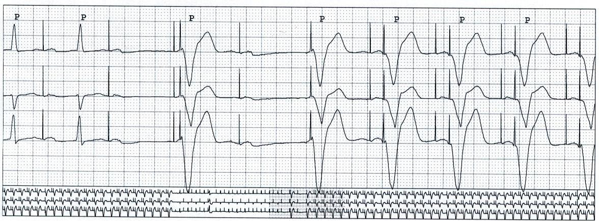 pacemaker/icd