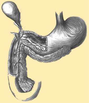 ibd bowel disease