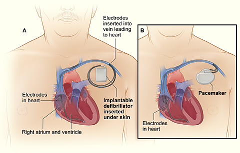 icd pacemakers