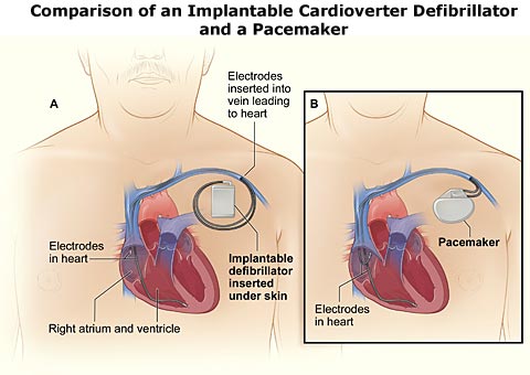 icd pacemakers