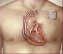 icd cardiac