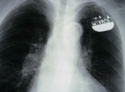 pacemaker/icd