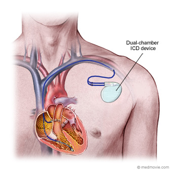 icd procedure