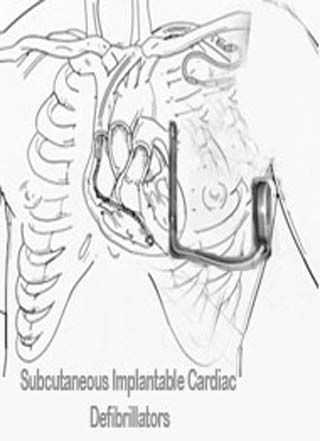 icd cardiac