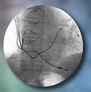 icd cardiac