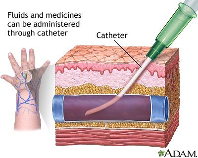 iv infusion